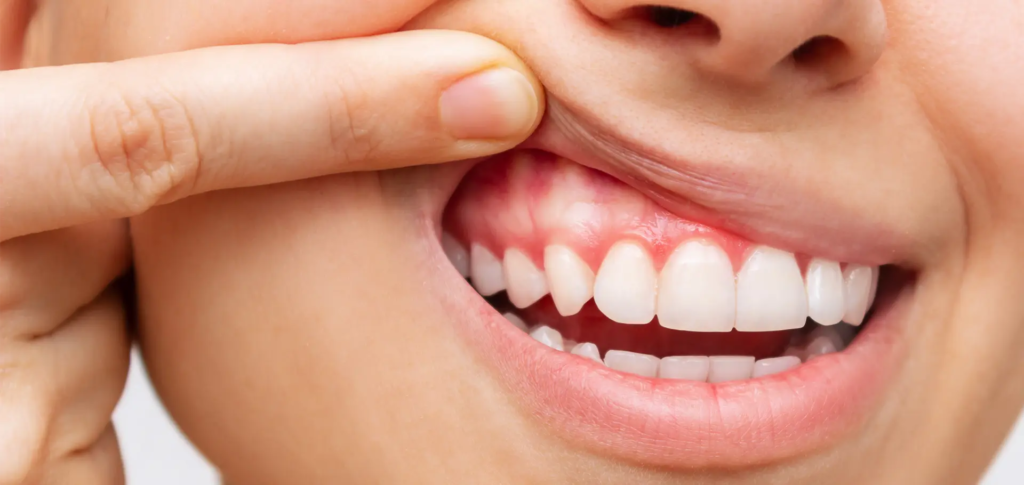 Dziękuję za informację. Zaktualizuję propozycje nazw plików i opisów alt, aby używać poprawnej nazwy „SmileClinic” (bez spacji). Oto zaktualizowane wersje dla każdego zdjęcia, zachowując polskie znaki w nazwach plików zgodnie z Twoją wcześniejszą akceptacją. Zdjęcie 1: Uśmiech z palcem wskazującym przy dziąśle Proponowana nazwa pliku: zapalenie-przyzebia-usmiech-dziasla-SmileClinic-pl.jpg Proponowany opis alt (atrybut alternatywny): „Bliskie ujęcie uśmiechu młodej osoby z palcem wskazującym wskazującym na zaczerwienione i opuchnięte dziąsła, co może wskazywać na zapalenie przyzębia. Zdjęcie ilustruje problem zdrowotny jamy ustnej i potrzebę leczenia, oferowanego przez klinikę stomatologiczną SmileClinic, aby ocalić uśmiech.