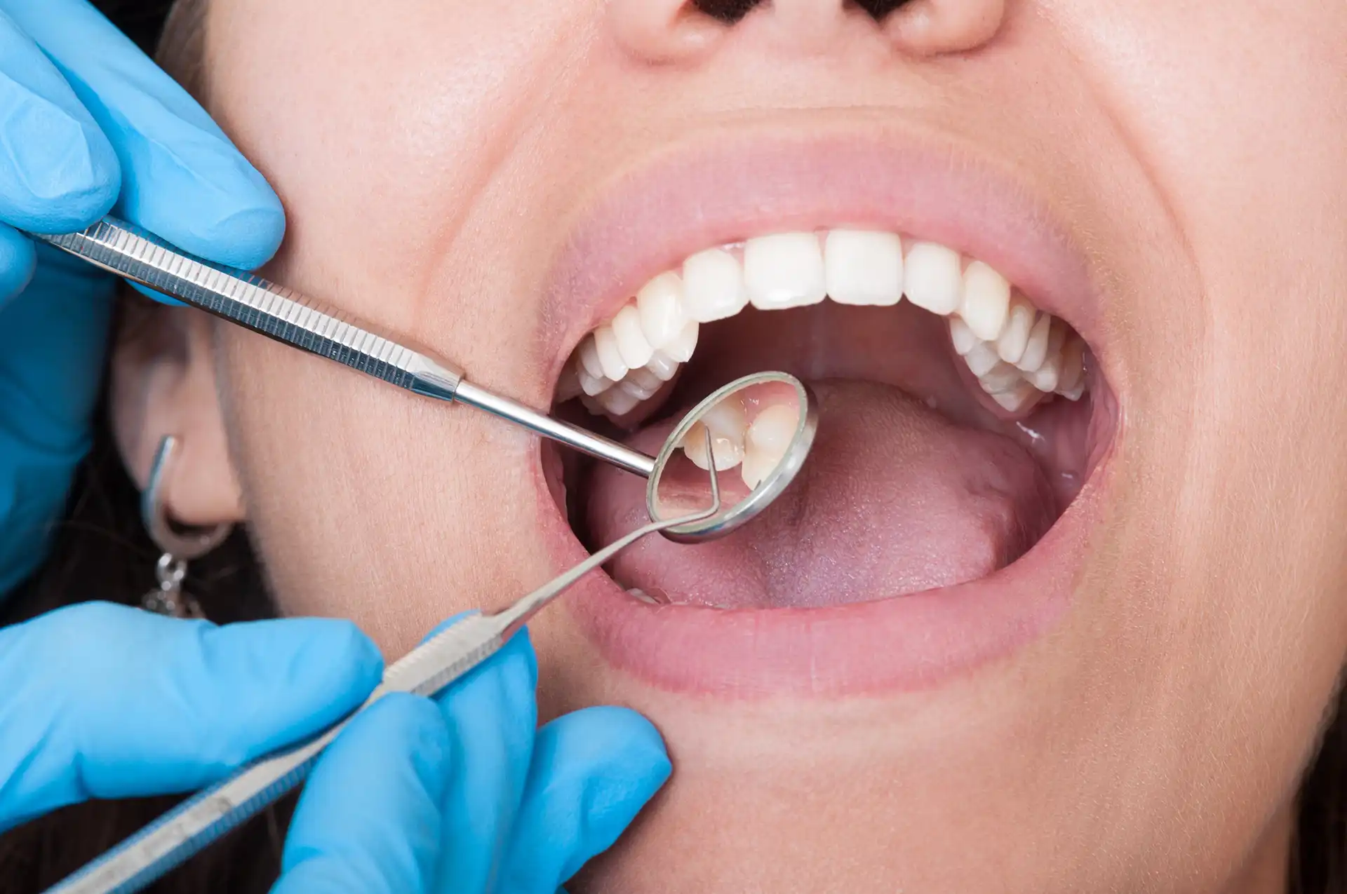 Profesjonalne narzędzia stomatologiczne używane podczas zabiegów implantologicznych w SmileClinic Narzędzia dentystyczne i otwarte usta z pięknymi zębami