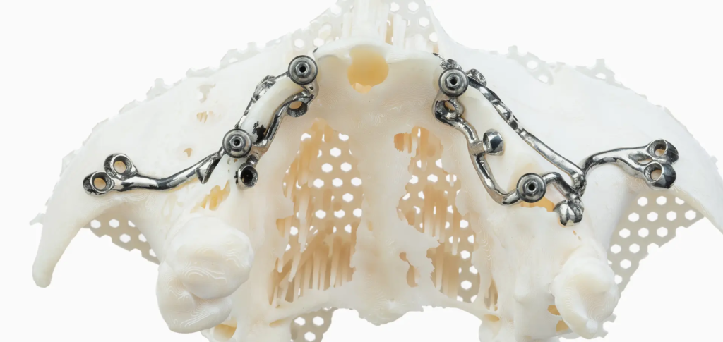 Implant podokostnowy (subperiostalny) stosowany w SmileClinic jako alternatywne rozwiązanie dla pacjentów z zaawansowanym zanikiem kości szczęki, gdzie tradycyjna implantacja jest niemożliwa bez rozbudowanych zabiegów odbudowy kostnej.