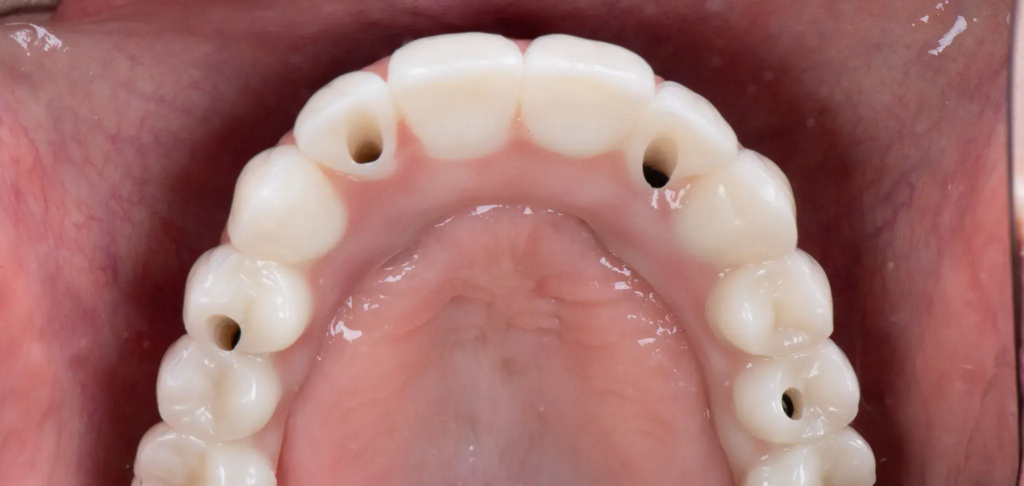 Precyzyjnie wykonana górna proteza All-on-4 w SmileClinic z widocznymi punktami kotwiczenia na implantach zapewniającymi stabilność i komfort użytkowania.