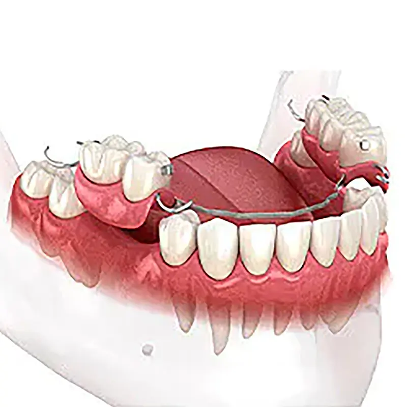 Proteza ruchoma częściowa wykonywana w SmileClinic - zdejmowane uzupełnienie protetyczne stosowane przy brakach skrzydłowych, które pacjent może samodzielnie wyjmować z jamy ustnej dla zapewnienia prawidłowej higieny.