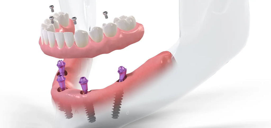 Innowacyjny system implantologiczny All-on-4 stosowany w SmileClinic - wizualizacja pokazująca precyzyjne rozmieszczenie czterech implantów podtrzymujących pełny łuk zębowy, pozwalając na natychmiastowe obciążenie i funkcjonowanie.