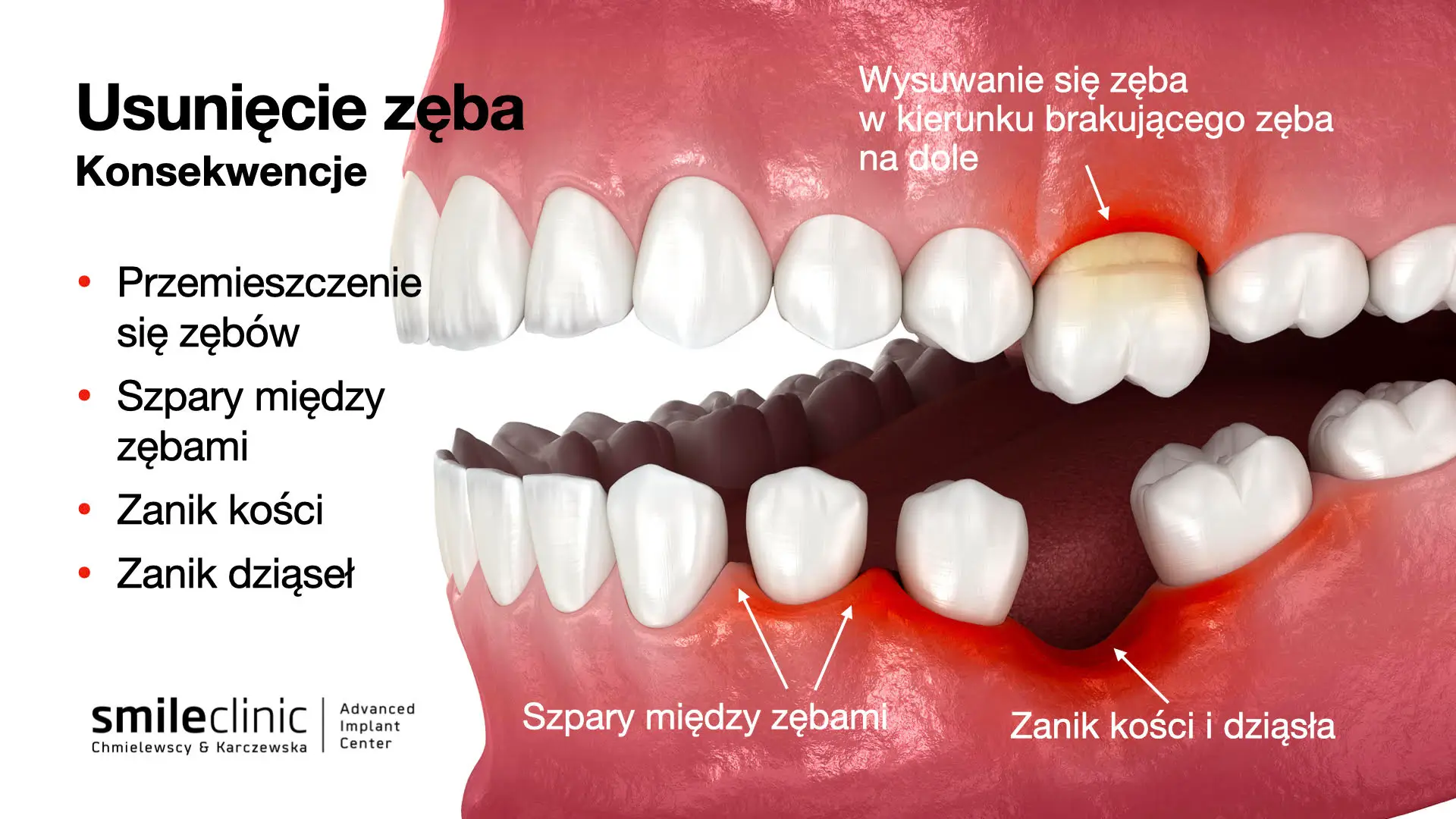 Konsekwencje usunięcia zęba trzonowego w żuchwie Konsekwencje usunięcia zęba trzonowego w żuchwie