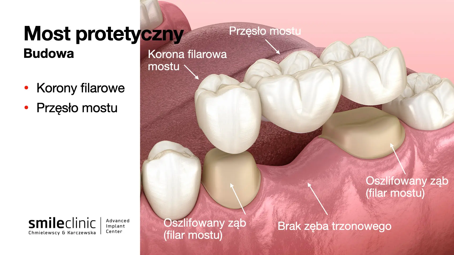 Most protetyczny uzupełniający brak pojedynczego zęba Most protetyczny uzupełniający brak pojedynczego zęba