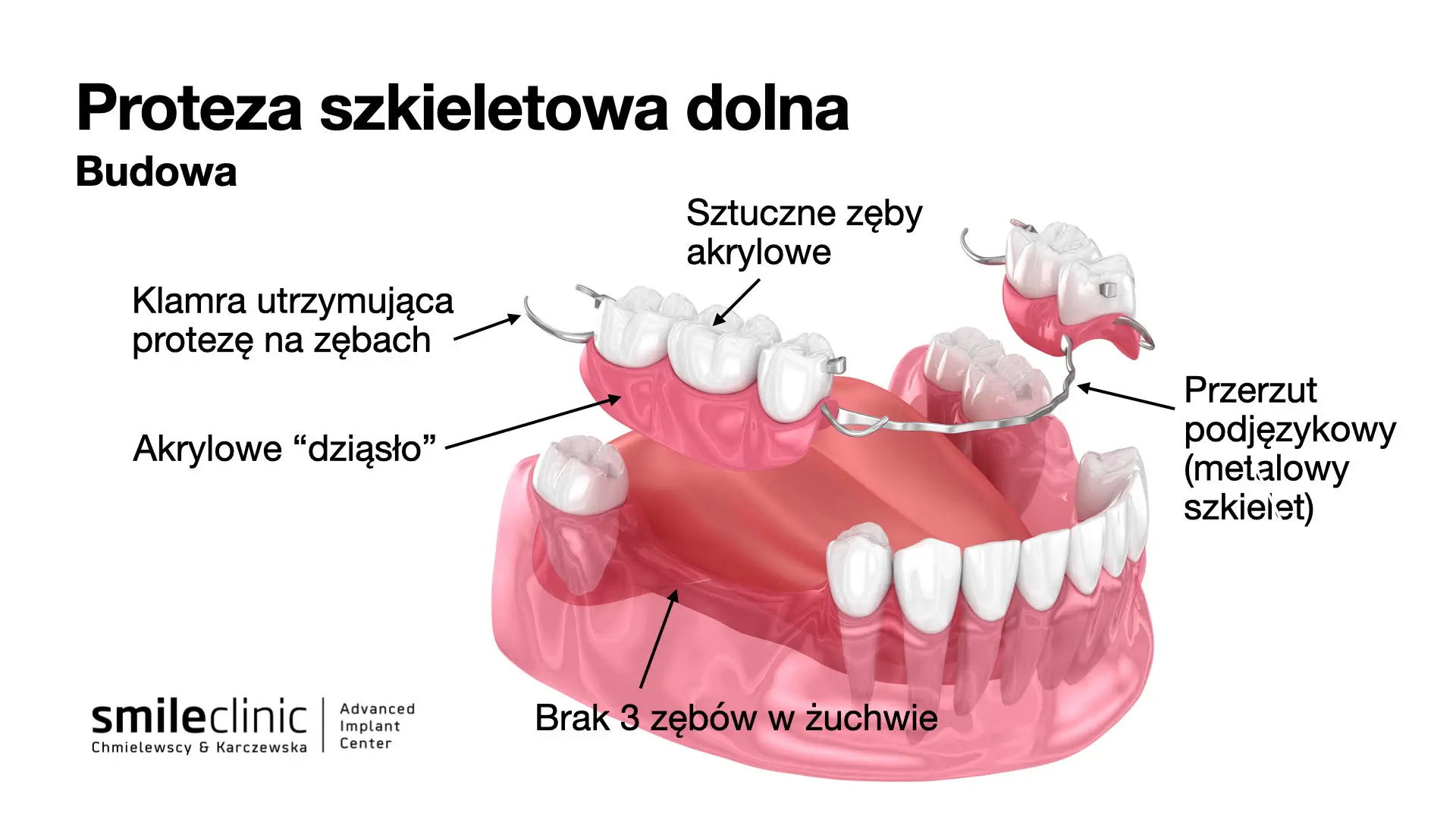 Proteza ruchoma (szkieletowa) uzupełniająca brak kilku zębów w żuchwie Proteza ruchoma (szkieletowa) uzupełniająca brak kilku zębów w żuchwie