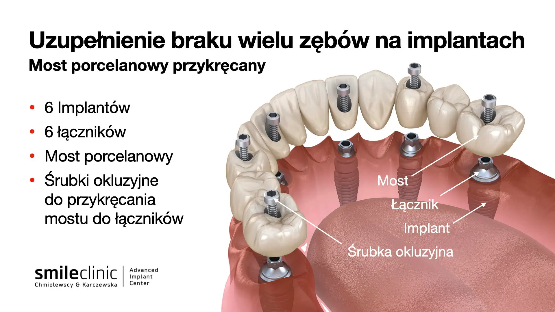 Most porcelanowy w żuchwie przykręcany do 6 implantów Most porcelanowy w żuchwie przykręcany do 6 implantów