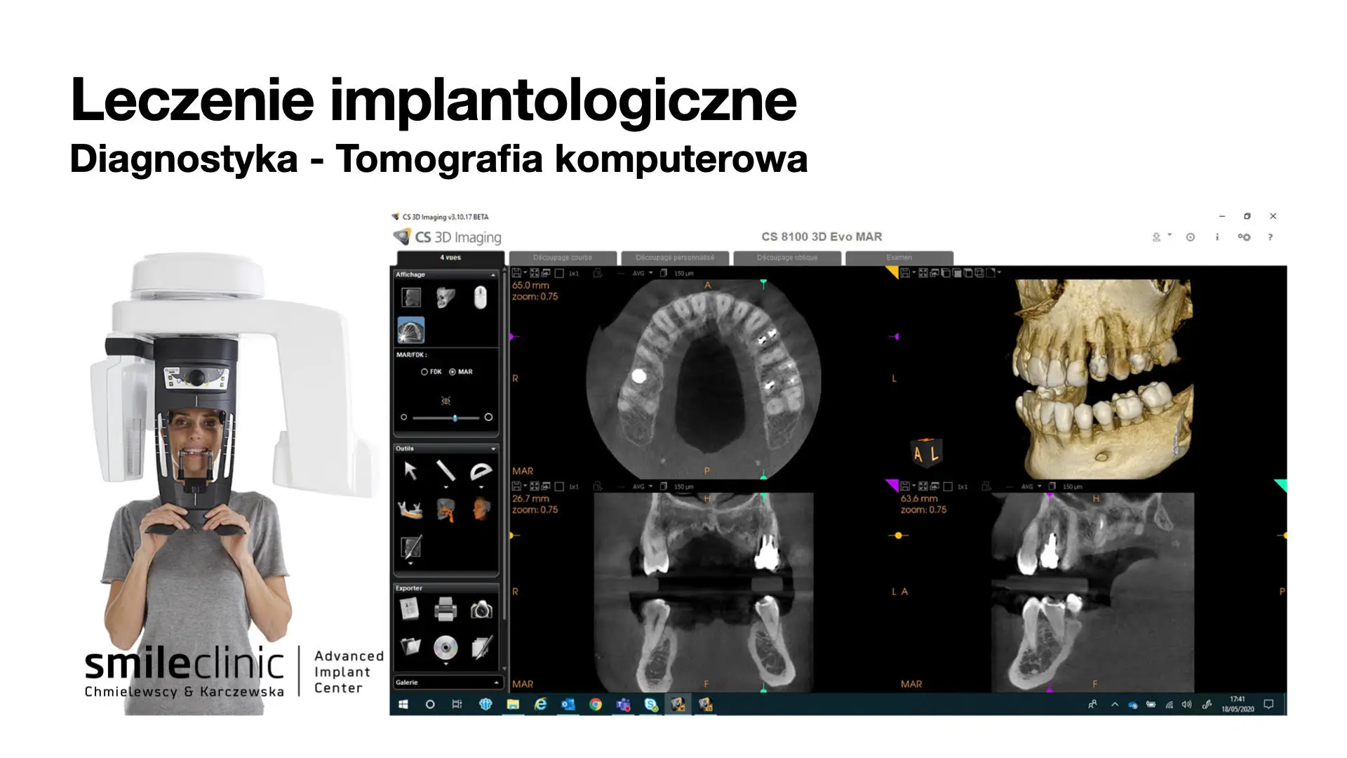 Tomografia komputerowa pozwala na obrazowanie kości 3D. Tomografia komputerowa pozwala na obrazowanie kości 3D.