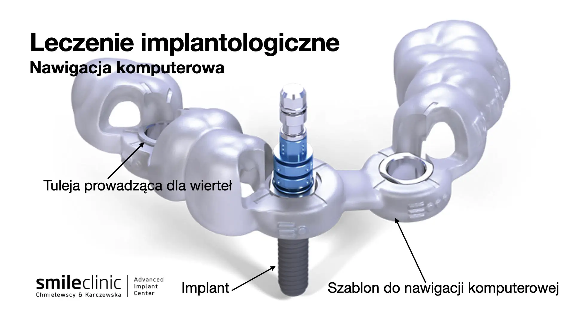 Szablon do nawigacji komputerowej w jamie ustnej i preparacja pod implant. Szablon do nawigacji komputerowej w jamie ustnej i preparacja pod implant.