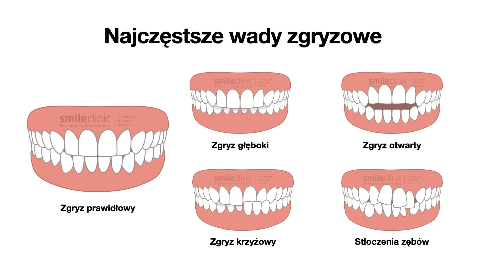 Wady zgryzowe.001