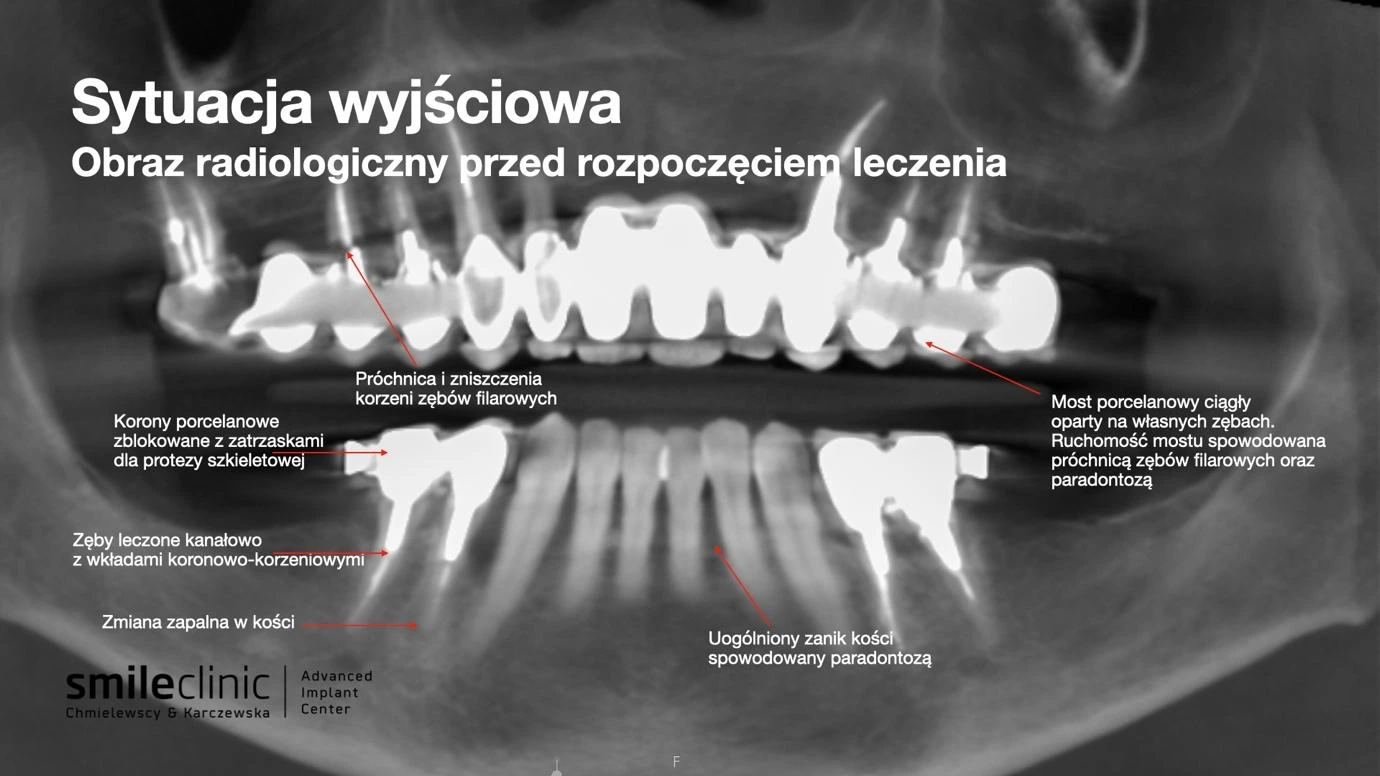 Sytuacja wyjściowa – RTG przed leczeniem All-on-6 Obraz radiologiczny przed leczeniem implantologicznym All-on-6 – próchnica i zanik kości