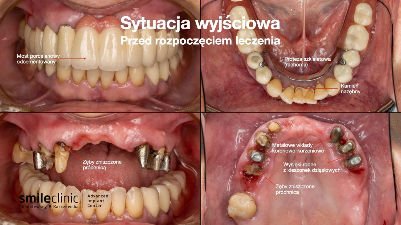 Sytuacja wyjściowa przed All-on-6 Sytuacja wyjściowa jamy ustnej pacjentki przed leczeniem implantologicznym All-on-6