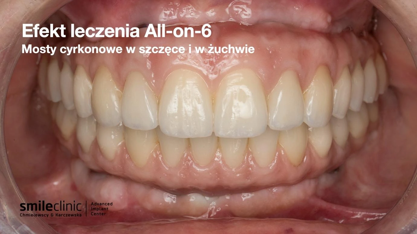 All-on-6 mosty cyrkonowe w szczęce i żuchwie Mosty cyrkonowe na implantach All-on-6 w szczęce i żuchwie