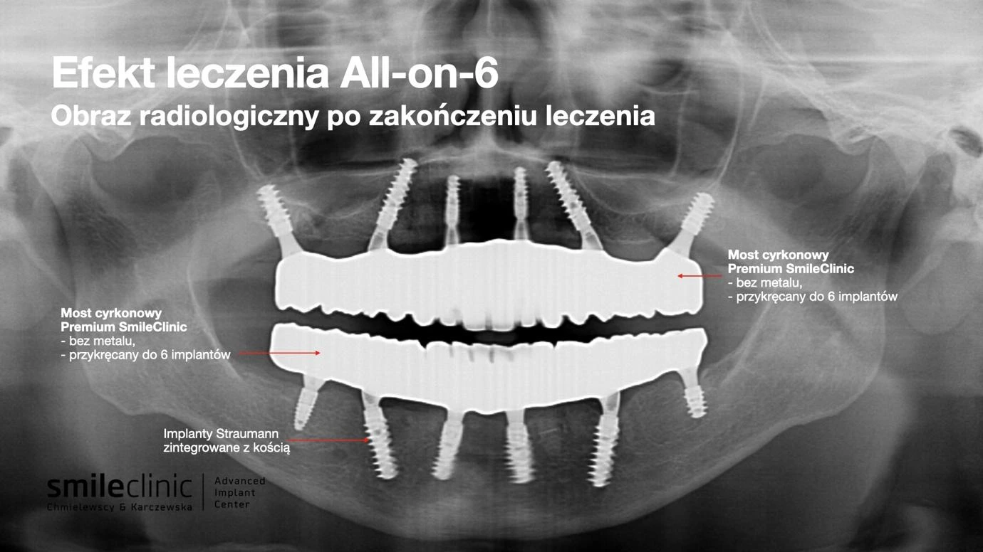 Efekt leczenia All-on-6 – RTG po zabiegu Obraz radiologiczny po leczeniu implantologicznym All-on-6 – mosty cyrkonowe na implantach Straumann