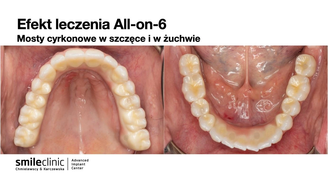 All-on-6 – widok mostów cyrkonowych Widok od góry i od dołu mostów cyrkonowych na implantach All-on-6