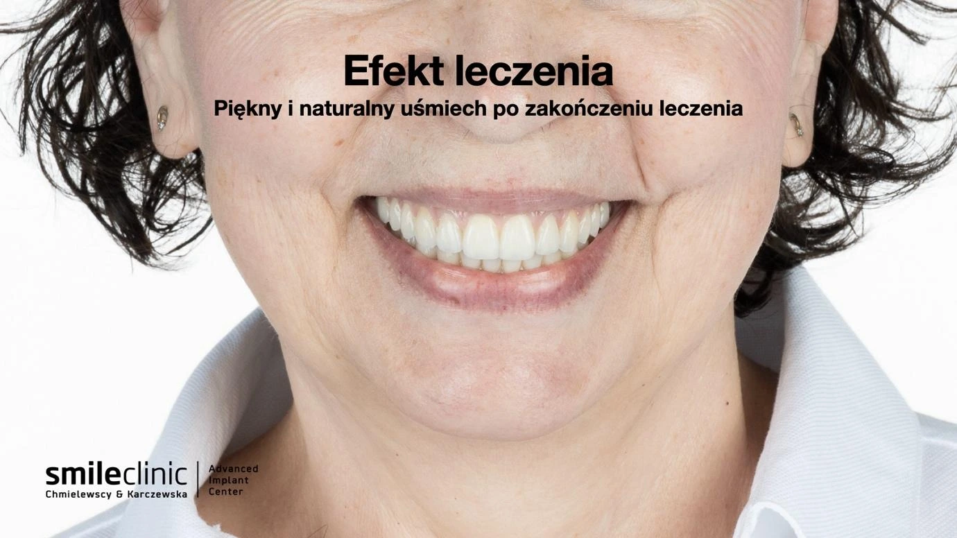 Efekt leczenia All-on-6 – naturalny uśmiech Piękny i naturalny uśmiech po leczeniu implantologicznym All-on-6