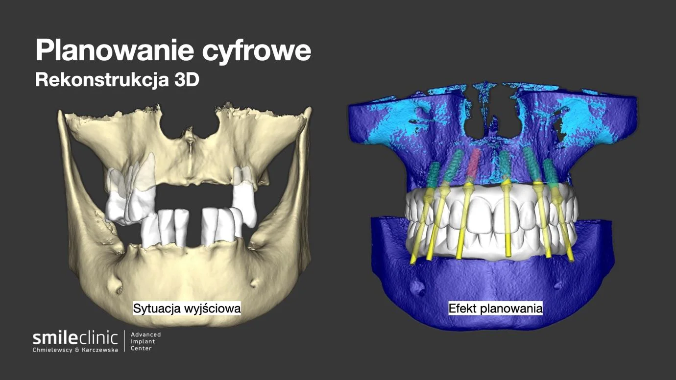 image12 Porównanie cyfrowej rekonstrukcji 3D szczęki przed leczeniem implantologicznym i po zaplanowaniu pozycji implantów
