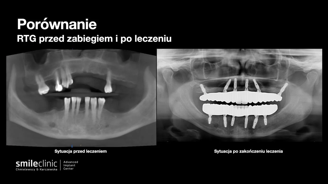 image2 Porównanie zdjęć RTG pacjentki przed leczeniem implantologicznym i po zakończeniu terapii All-on-6