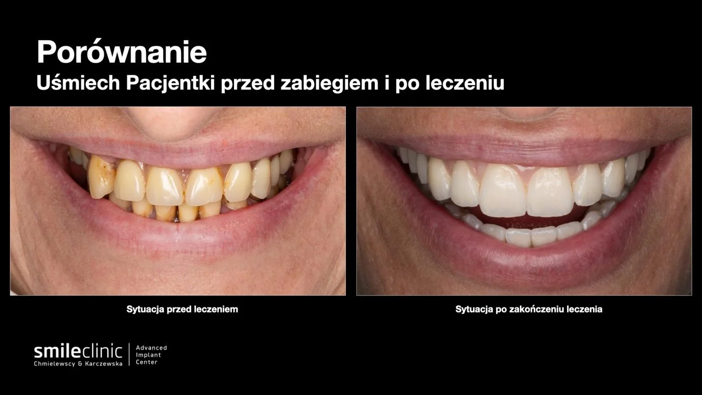 image3 Zbliżenie uśmiechu pacjentki przed leczeniem implantologicznym i po jego zakończeniu