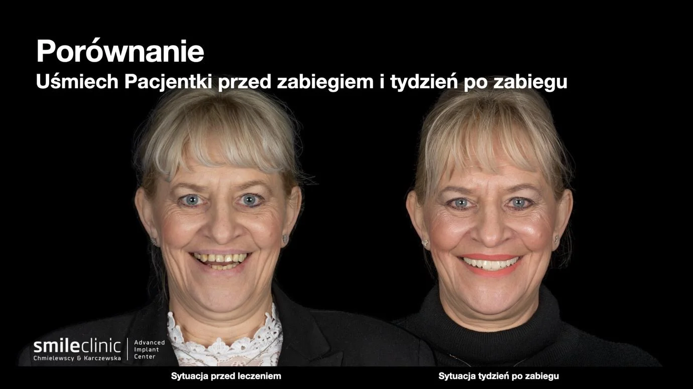 image4 Porównanie uśmiechu pacjentki przed leczeniem implantologicznym i tydzień po zabiegu