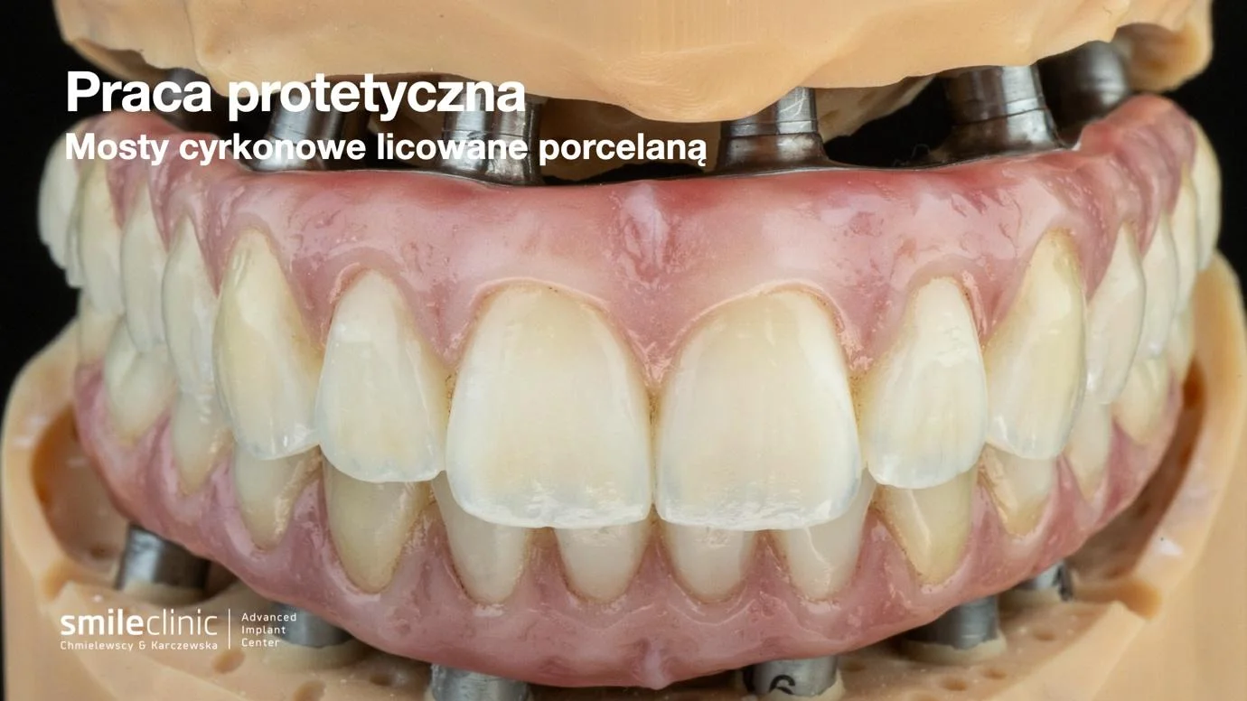 image5 Zbliżenie na mosty licowane porcelaną mocowane na implantach zębowych