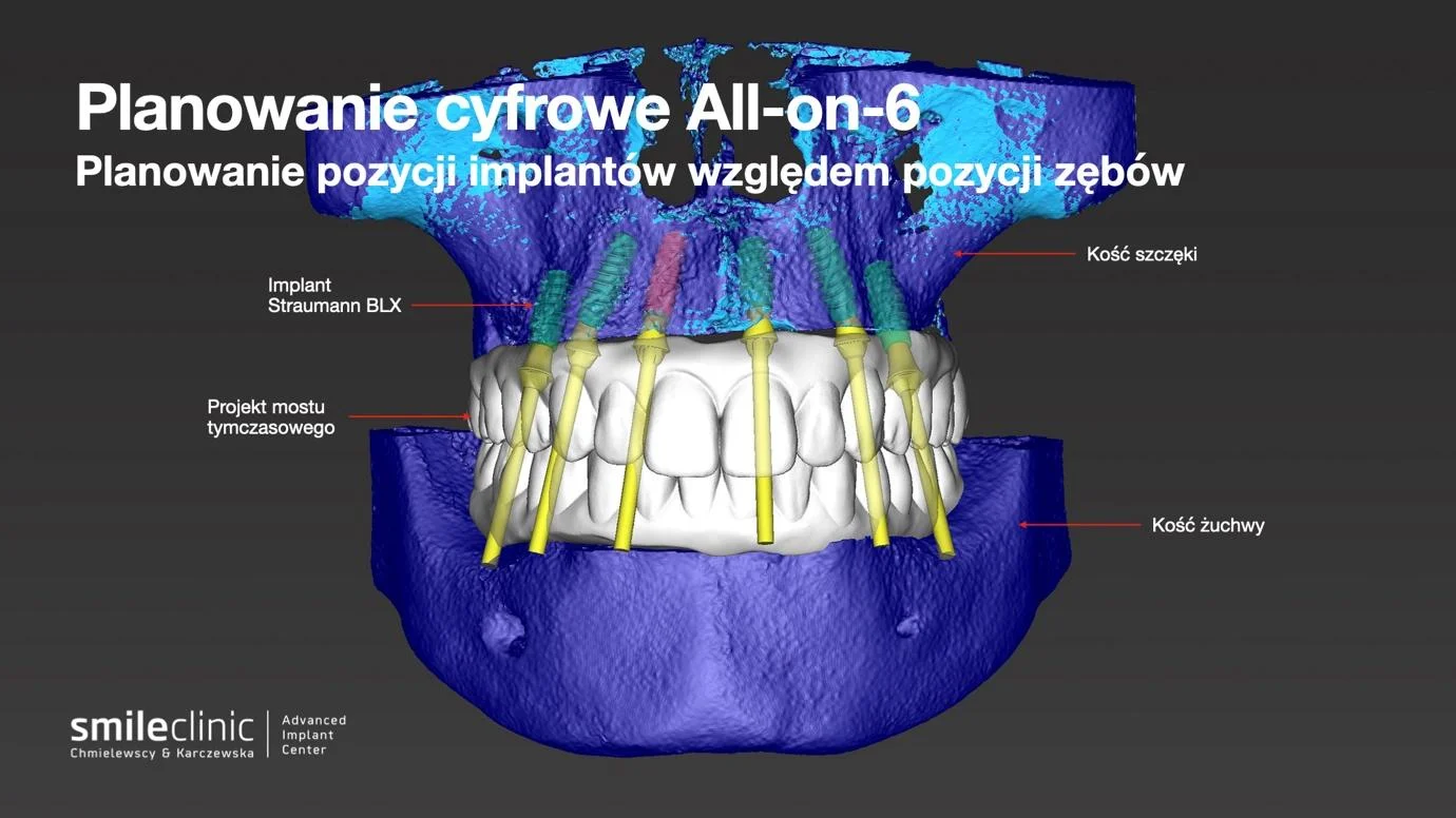 image7 Wizualizacja cyfrowego planowania implantów zębowych w technice All-on-6 z oznaczeniem kości i pozycji implantów