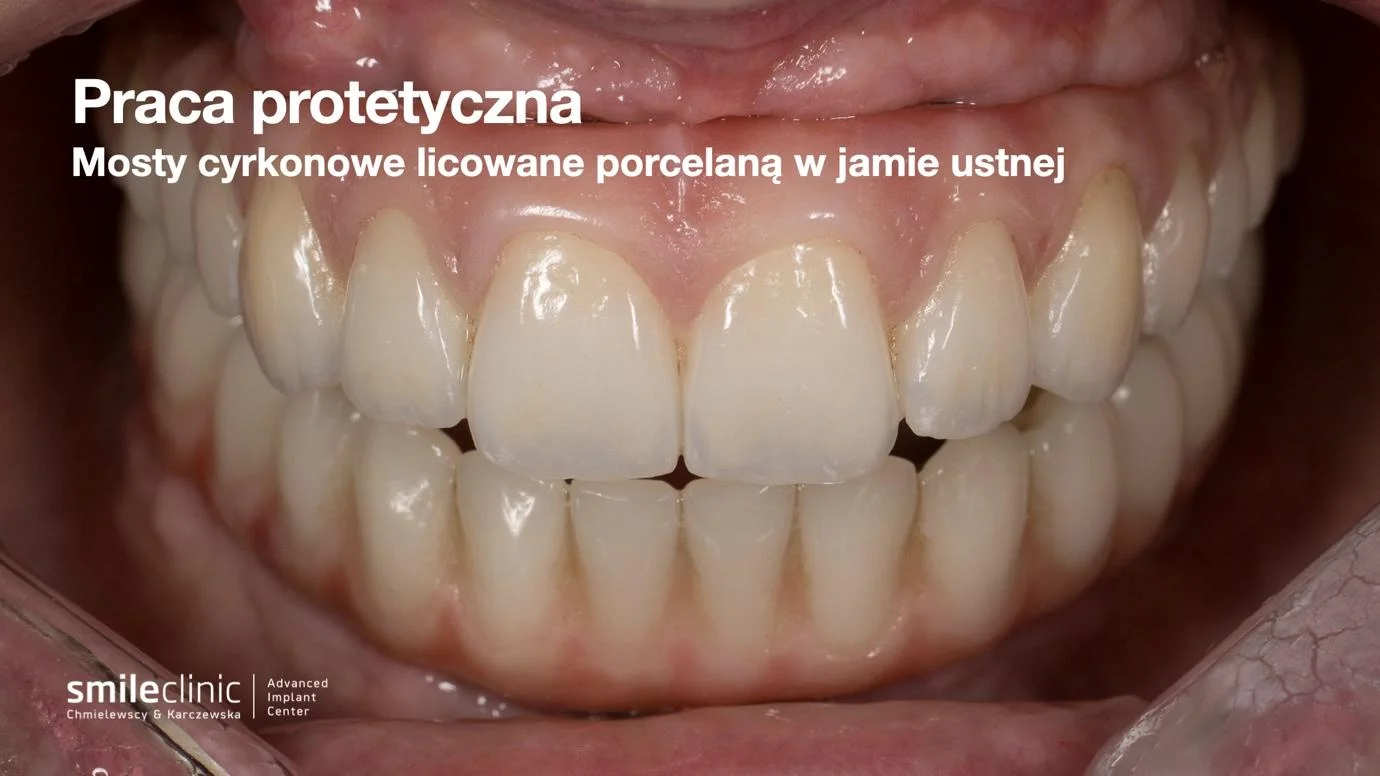 image8 Widok mostów cyrkonowych licowanych porcelaną zamocowanych w jamie ustnej pacjenta
