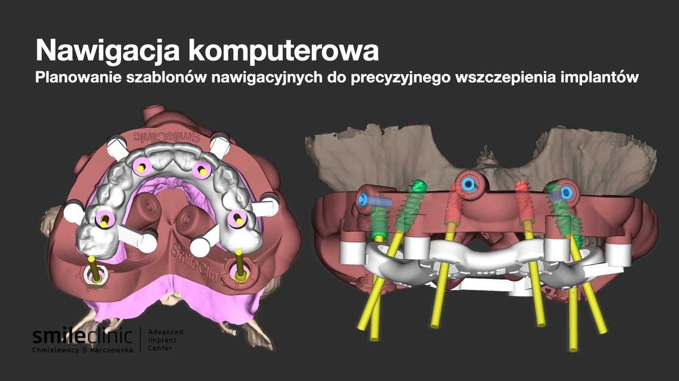 Nawigacja komputerowa All-on-6 Nawigacja komputerowa podczas planowania implantów All-on-6