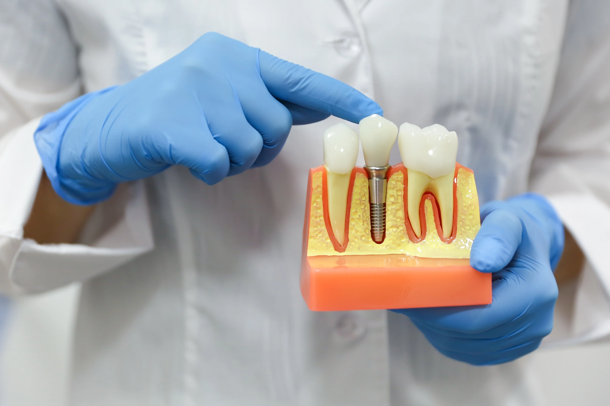 nowoczesne-technologie-w-implantologii-2 Dentysta prezentujący model implantu zębowego z koroną protetyczną