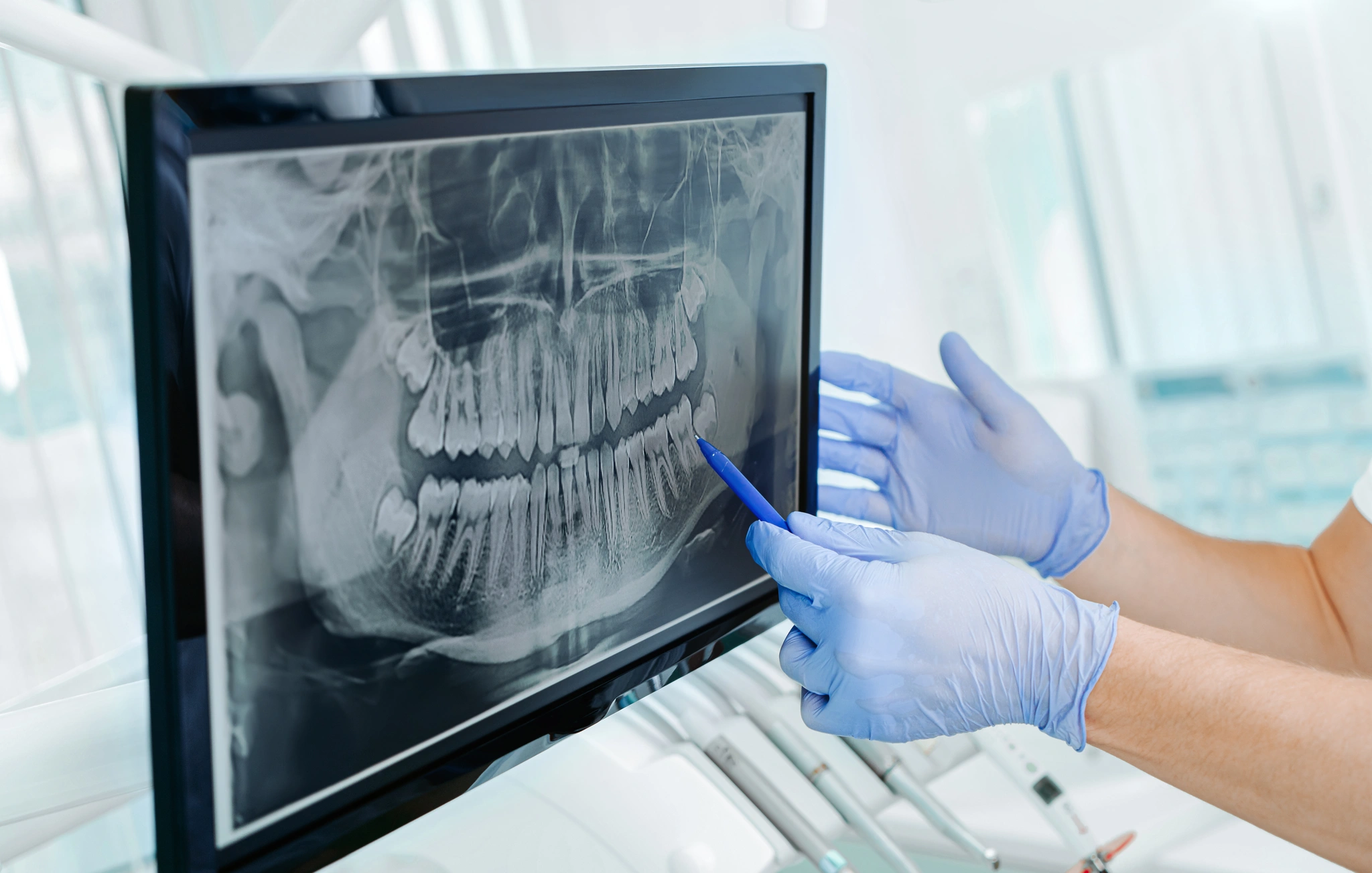 nowoczesne-technologie-w-implantologii-3 Dentysta wskazujący na zdjęcie RTG szczęki podczas planowania leczenia implantologicznego