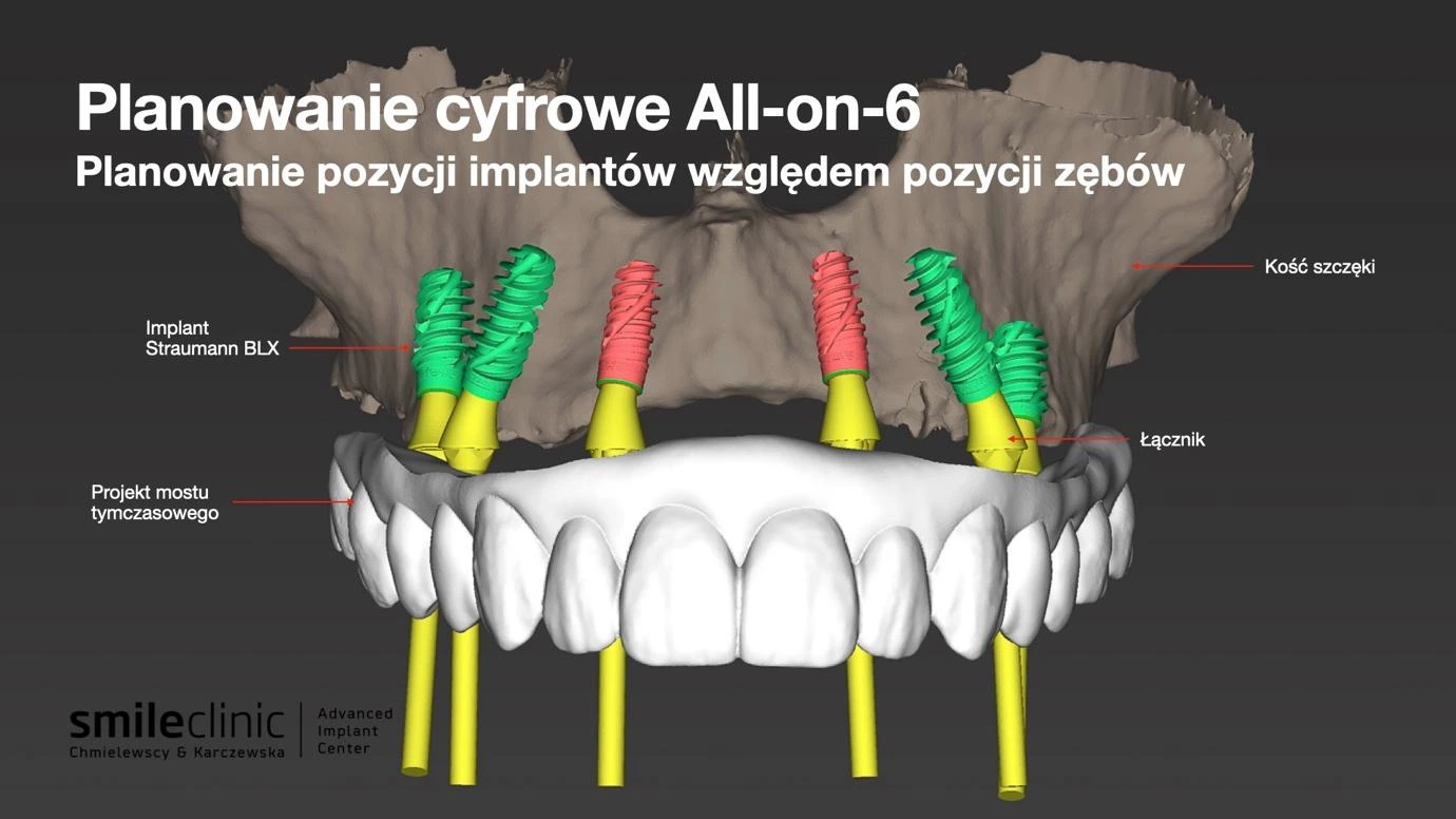 Planowanie cyfrowe implantów All-on-6 Planowanie cyfrowe implantów zębowych All-on-6 – wizualizacja pozycji implantów Straumann BLX