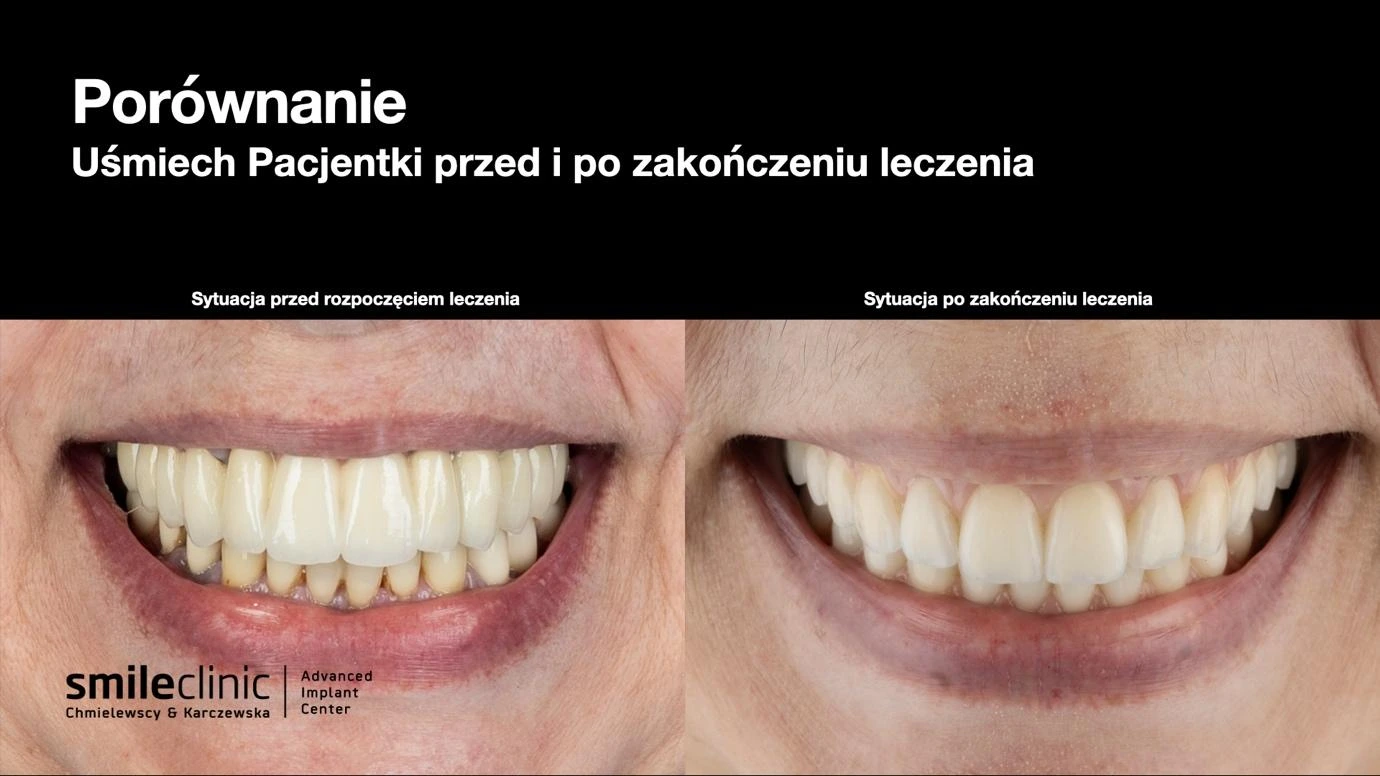 Uśmiech przed i po leczeniu All-on-6 Porównanie uśmiechu pacjentki przed i po leczeniu All-on-6