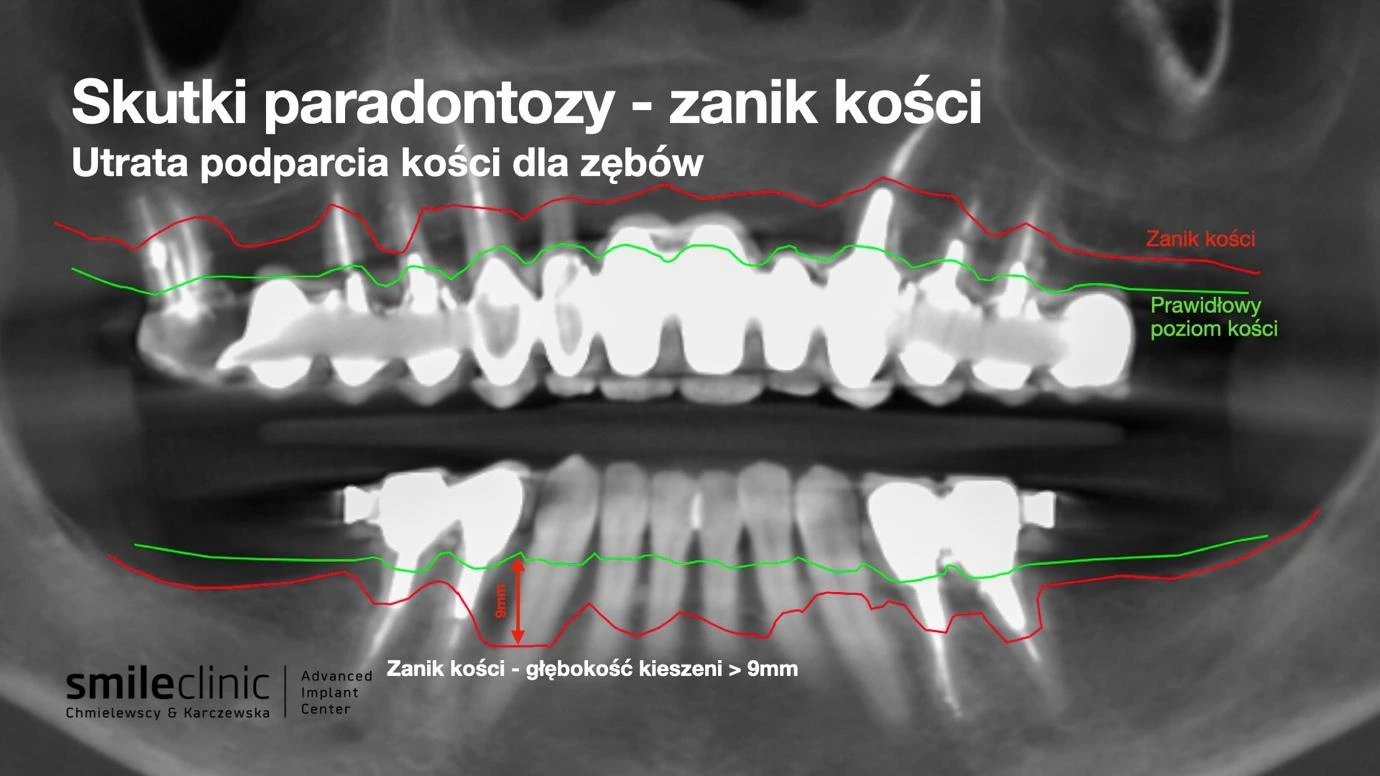 Zanik kości przy paradontozie Skutki paradontozy – zanik kości i utrata podparcia dla zębów