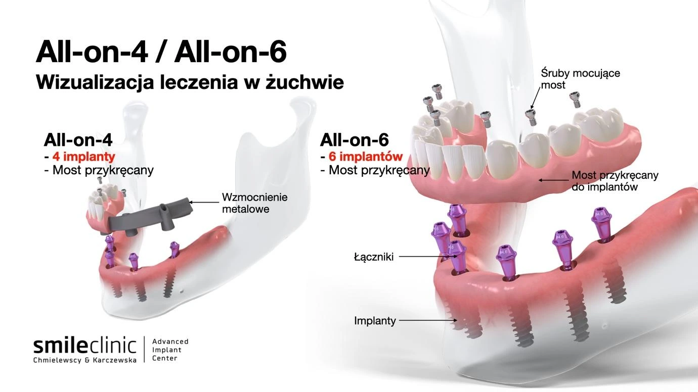 All-on-4 vs All-on-6 – różnice w implantach Porównanie metod All-on-4 i All-on-6 – wizualizacja leczenia implantologicznego